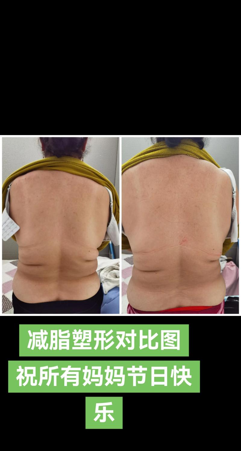 中医减肥